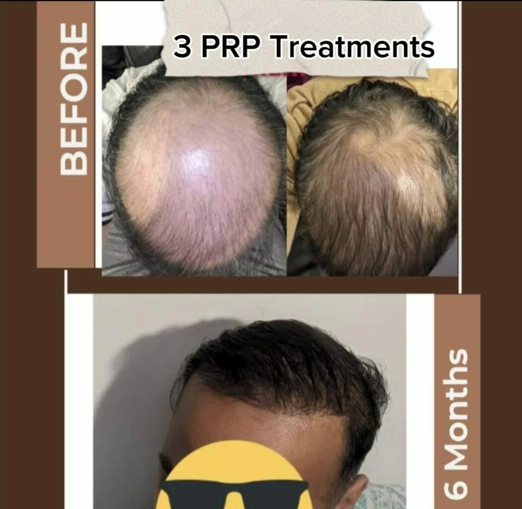 Rock Health Clinic practitioner preparing a regenerative hair treatment