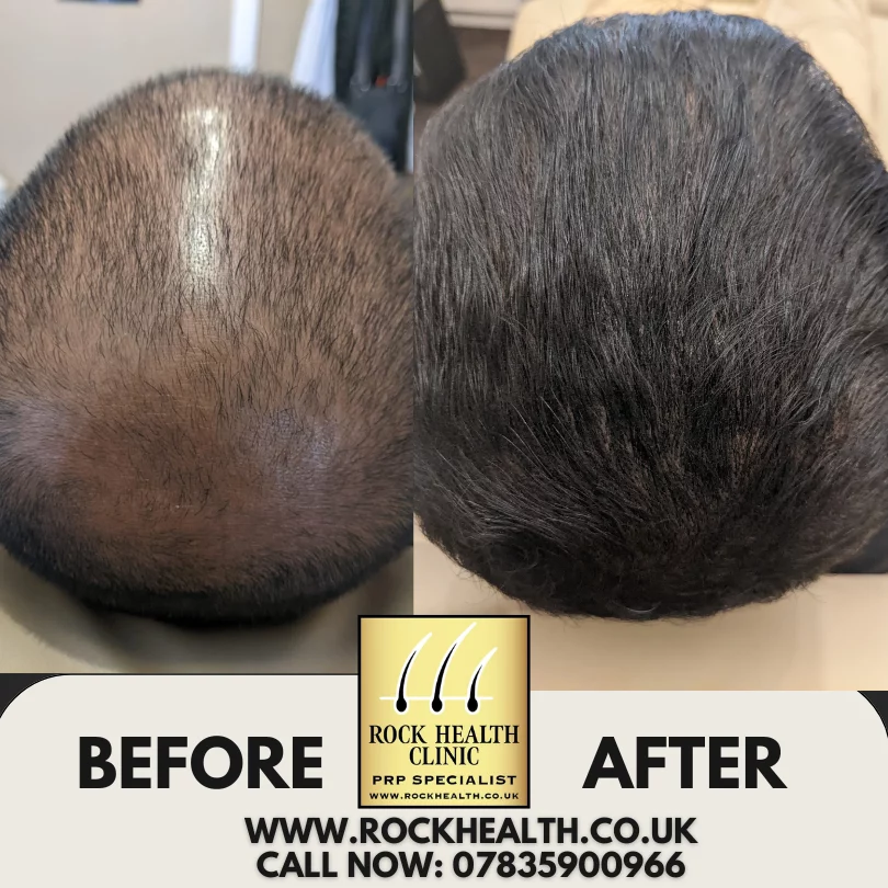 PRP hair loss results information from Rock Health Clinic Birmingham