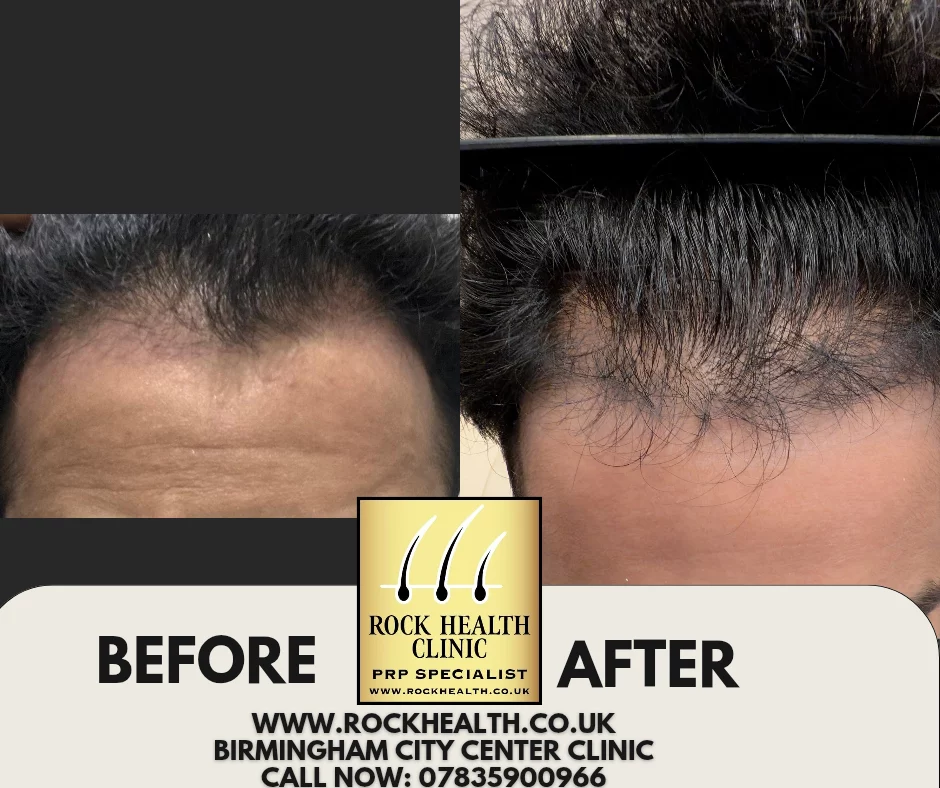 PRP and PRF treatment comparison from Rock Health Clinic Birmingham
