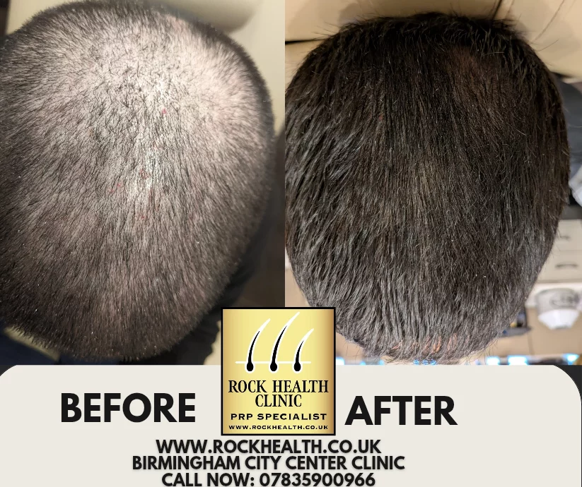 PRP consultation information from Rock Health Clinic Birmingham