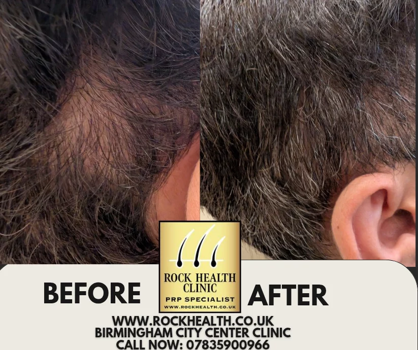 Hair regrowth before and after treatment result at Rock Health Clinic