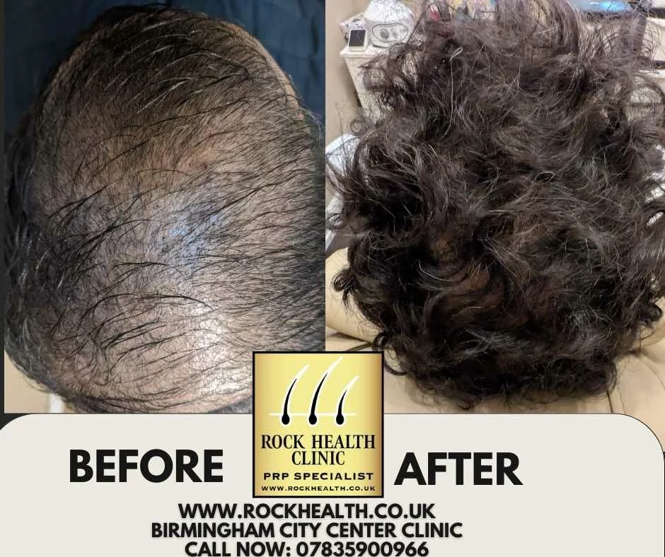 PRF and PRP treatment comparison at Rock Health Clinic