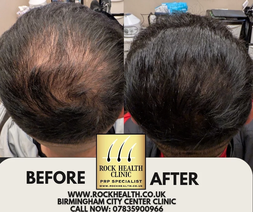PRP hair regrowth treatment information at Rock Health Clinic