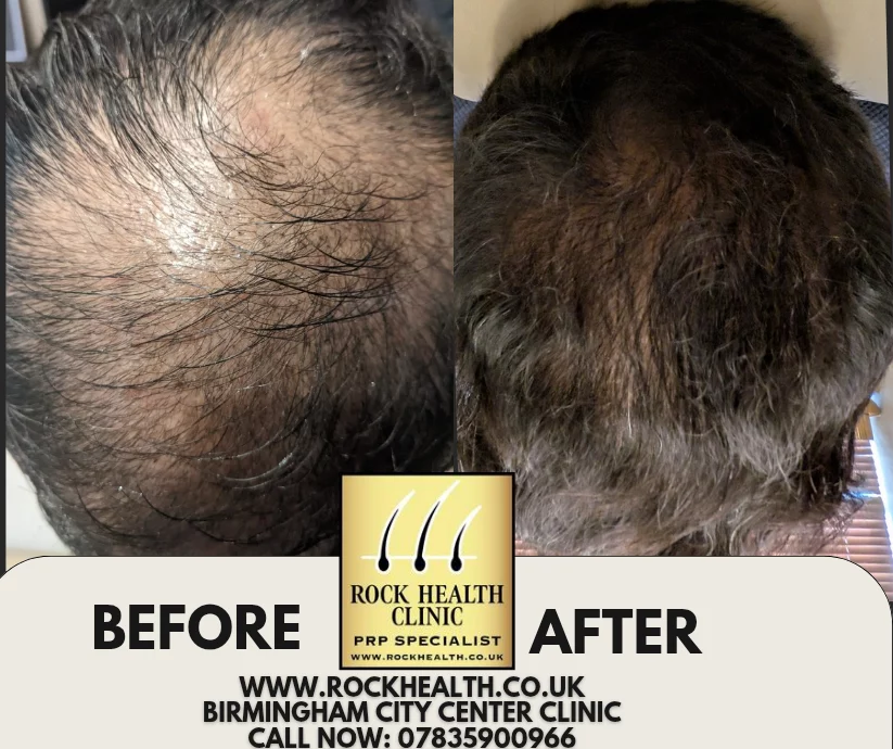 Hair regrowth before and after treatment result at Rock Health Clinic