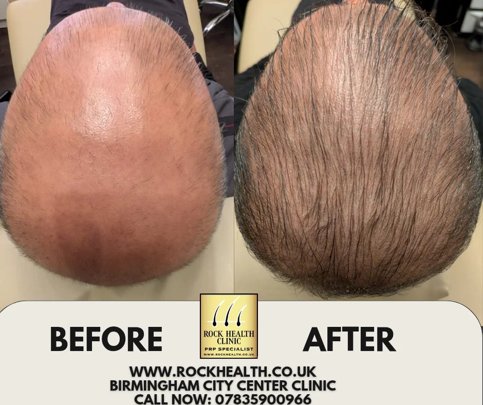 Hair regrowth before and after treatment result at Rock Health Clinic