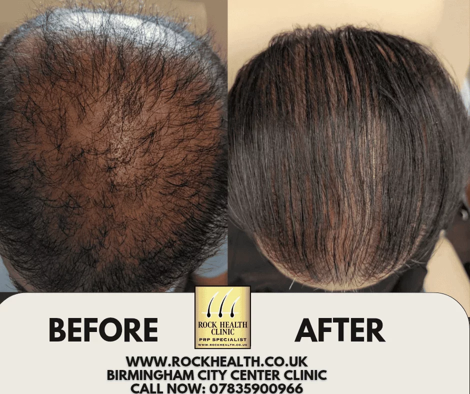 Hair regrowth before and after treatment result at Rock Health Clinic