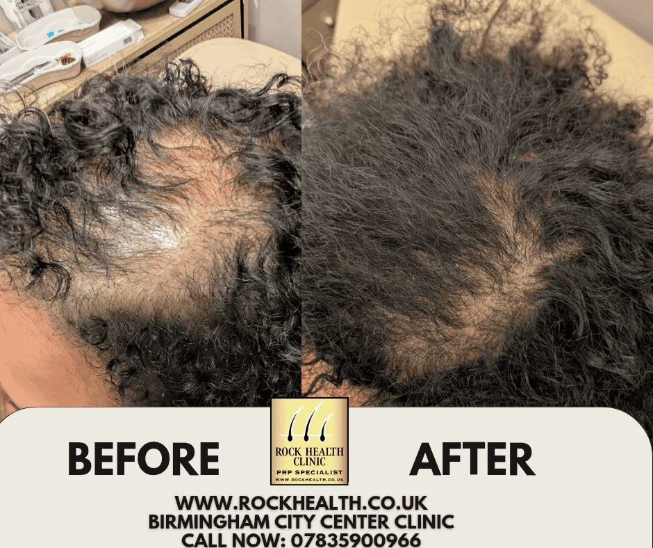 Hair regrowth before and after treatment result at Rock Health Clinic