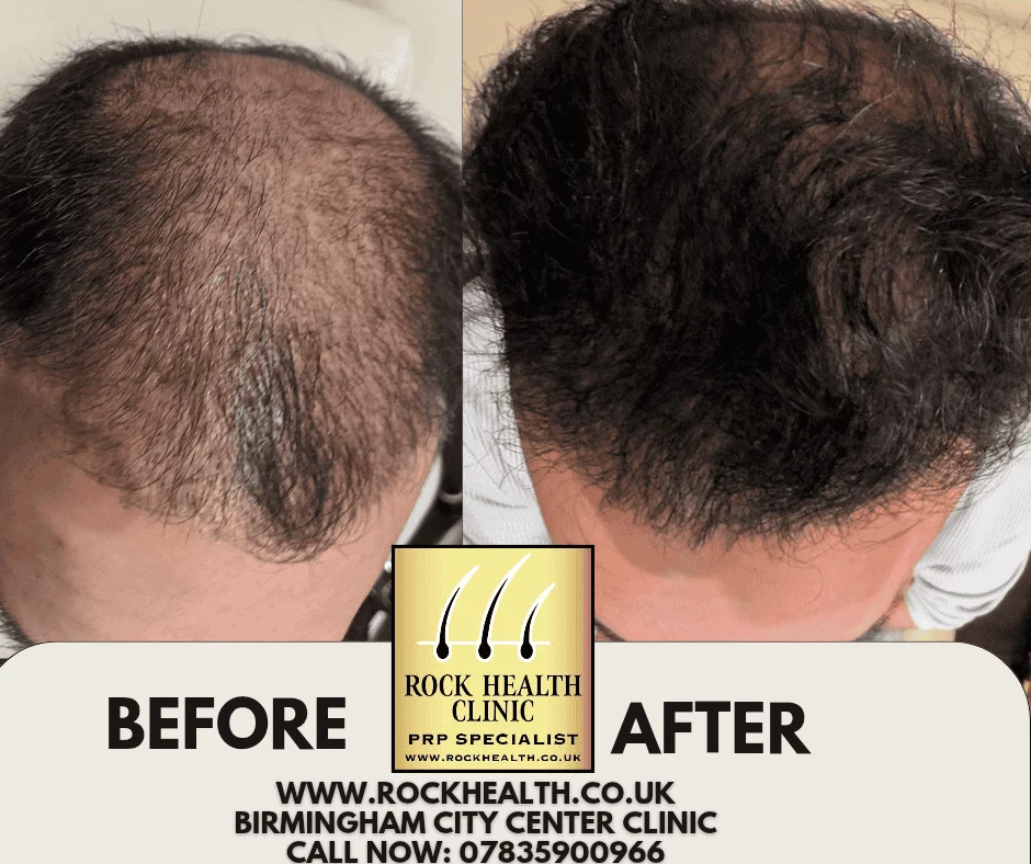 Hair regrowth before and after treatment result at Rock Health Clinic