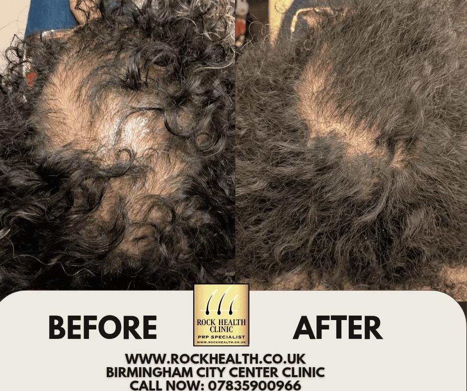 Hair regrowth before and after treatment result at Rock Health Clinic