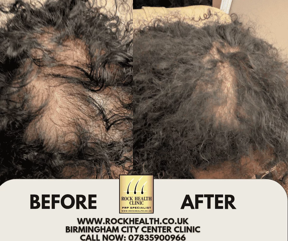 Hair regrowth before and after treatment result at Rock Health Clinic