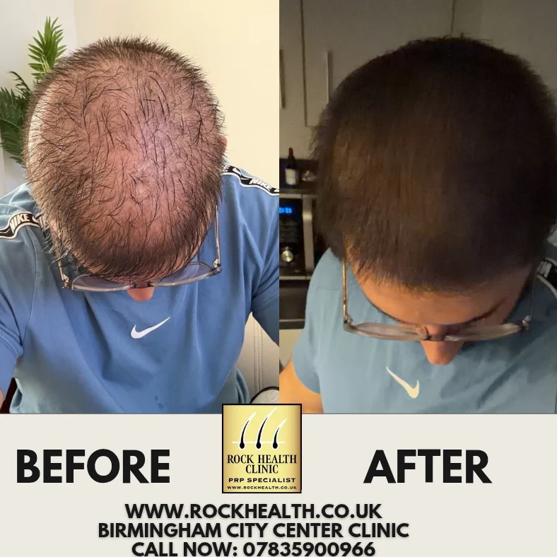 Hair regrowth before and after treatment result at Rock Health Clinic at Rock Health Clinic