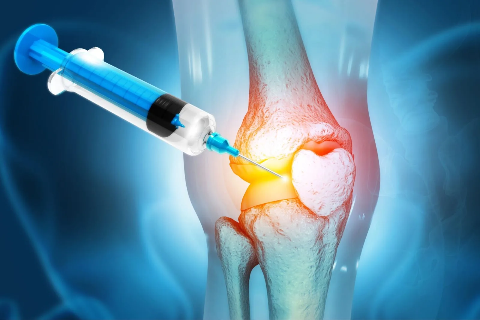 PRP injection illustration for knee pain treatment