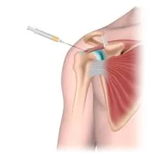 PRP injection illustration for shoulder pain treatment