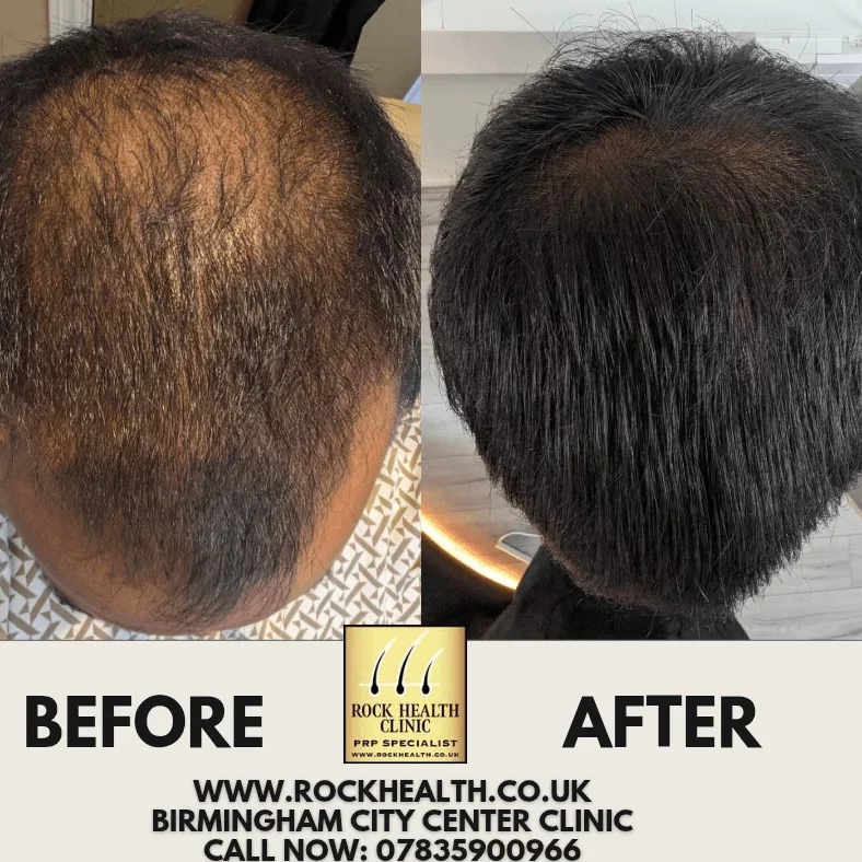 Before and after hair results